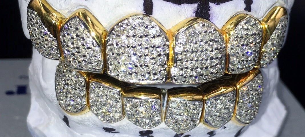 Shalimar Custom Jewelers » Gold Teeth With Diamonds